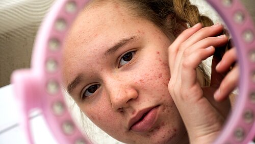 Jugendliches Mädchen mit Akne im Gesicht